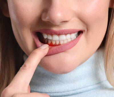 Zahnfleischentzündung