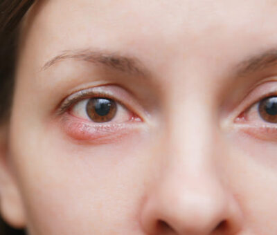 Schwellung der Augenlider.