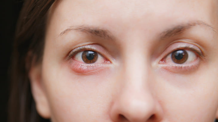 Schwellung der Augenlider.